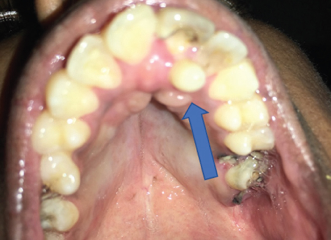 Talon cusp is an extra cusp on an anterior tooth (arrow).